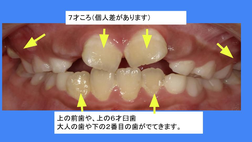 特別な永久歯の形 上の側切歯の盲孔（もうこう）｜はえかわり中の治療なら池田歯科医院