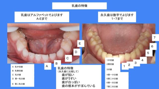 特別な永久歯の形 上の側切歯の切歯結節｜はえかわり中の治療なら池田歯科医院