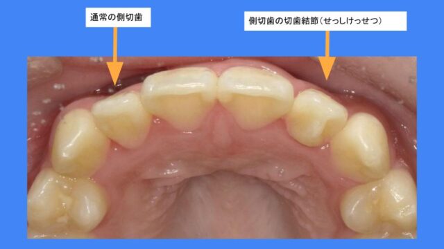 特別な永久歯の形 上の側切歯の切歯結節｜はえかわり中の治療なら池田歯科医院