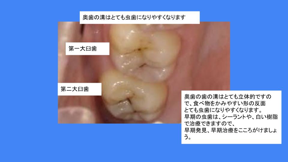 歯の溝はとても虫歯になりやすいので気をつけましょう はえかわり中の治療なら池田歯科医院